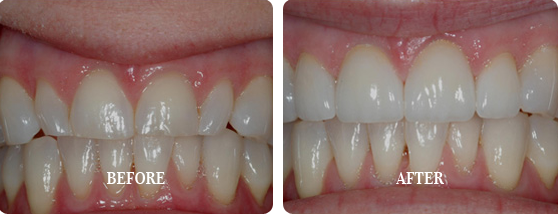 Before After Case 13