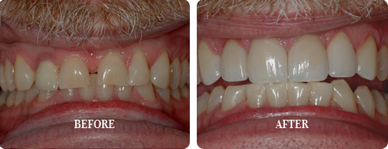 Before After Case 14