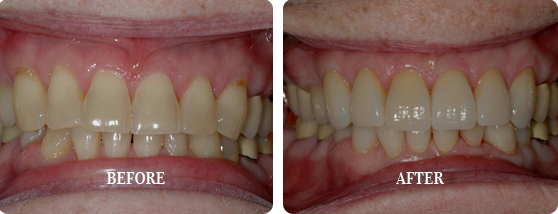 Before After Case 17