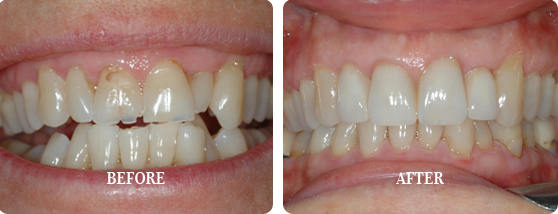 Before After Case 20