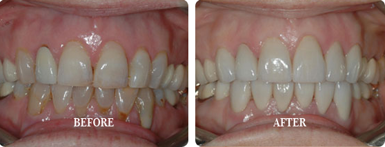 Before After Case 21
