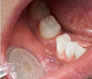 Gingivitis treatment in Austin, TX