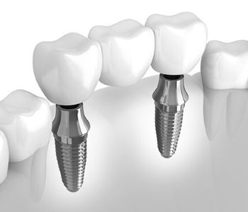 Understanding dental implants for replacement teeth in Austin, TX