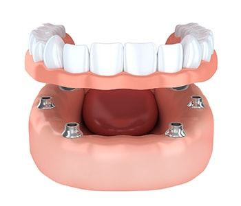 How Austin, TX patients benefit from implant tooth replacement