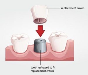 What is a Dental Crown Greenwood