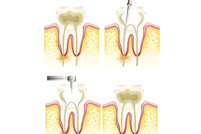 Root Canals Procedure