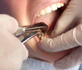 tooth extraction from dentist in greensboro