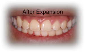 Orthodontics After Case 3 Orthodontics After Case 3