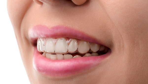 Invisalign, Newport Beach
