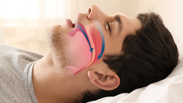 Sleep Apnea, Newport Beach