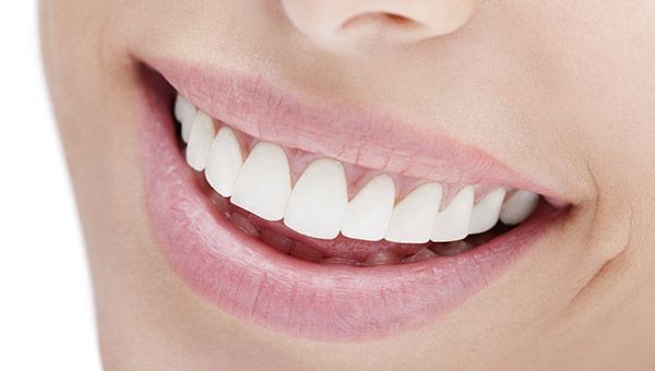 Veneers, Newport Beach