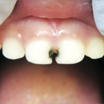 Baby teeth
