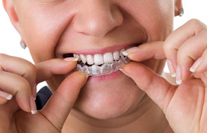 Transparent Teeth Braces