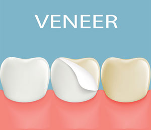 Dental Veneers