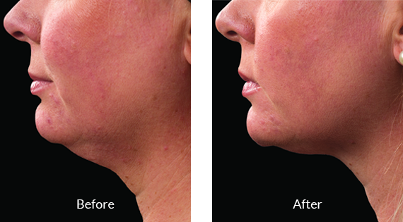 Before After Case - 3