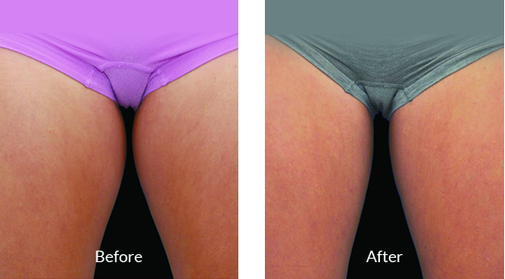 Before After Case - 4