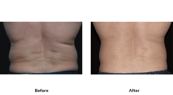 Before After Case - 5