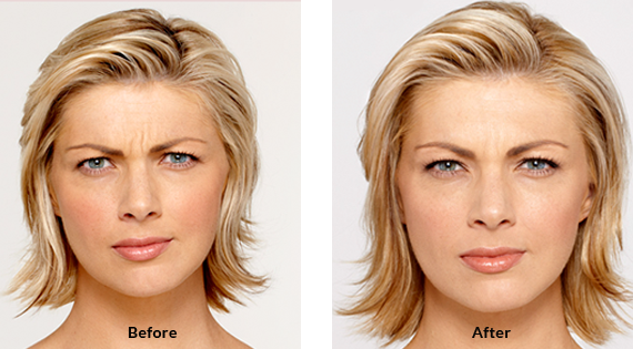 Before After Case - 7