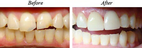 Veneers Before After 01
