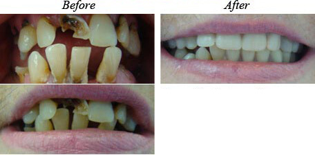 Removable Dentures Before After 02
