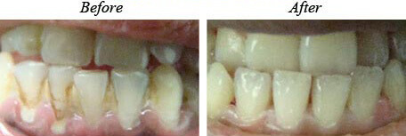 Teeth Cleaning Before After 01