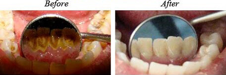 Teeth Cleaning Before After 02
