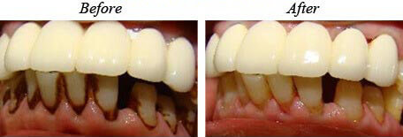 Teeth Cleaning Before After 03
