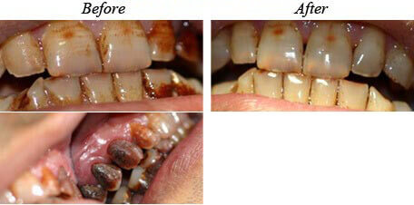 Teeth Cleaning Before After 04