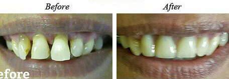 Dentures Before After 01