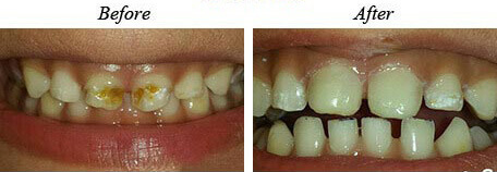 Cavities Before After 01