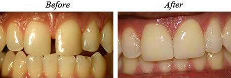 Veneers Before After 02