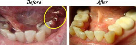 Porcelain Crowns Before After 01