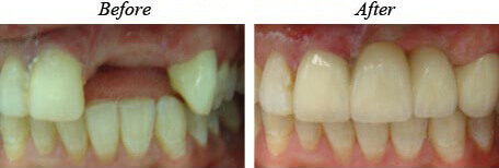 Fixed Bridge Before After 02