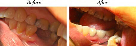 Fixed Bridge Before After 03