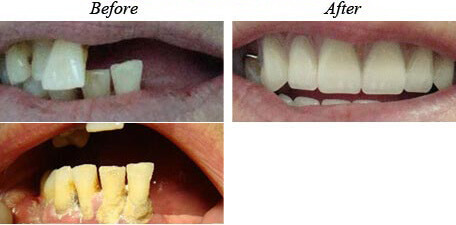 Removable Dentures Before After 01