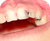 Cavity