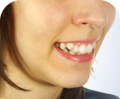 Crooked Teeth