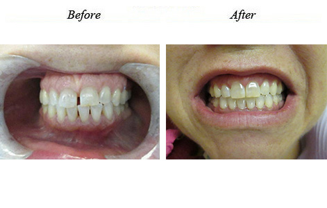 This patient is so happy with her beautiful smile! All spaces closed naturally with Invisalign treatment!