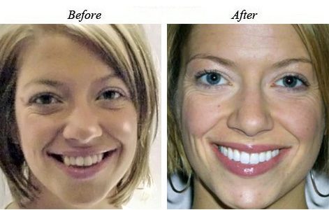 When the front teeth do not overlap properly, this is called an open bite.