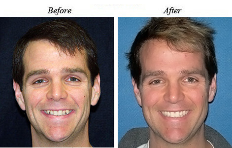 Class II is also called an overbite, when the lower back teeth bite too far behind the upper creating an overbite in the front.