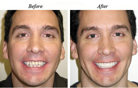 Crowding in the front teeth with good molar relationship.