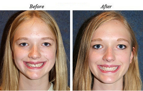 Spacing between the front teeth.