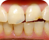 Worn Out Teeth