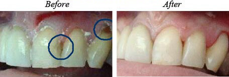 White filling before after