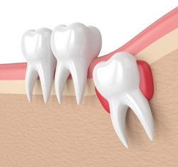 Wisdom teeth illustration