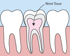 Root Canals Mississauga - Root Canals