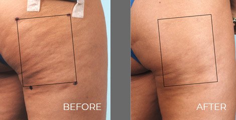Cellulaze Treatment - Before After Picture 01