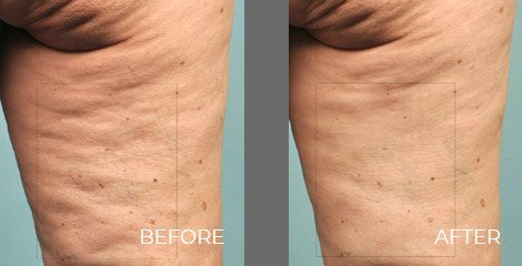 Cellulaze Treatment - Before After Picture 02