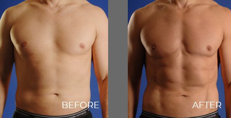 SmartLipo Treatment - Before After Picture 01