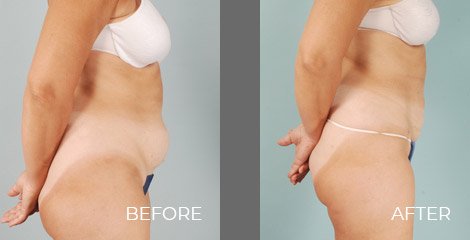 SmartLipo Treatment - Before After Picture 02